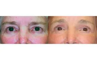 Before and after photo of an actual Eyelid Surgery patient.