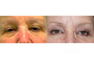 Before and after photo of an actual Eyelid Surgery patient.