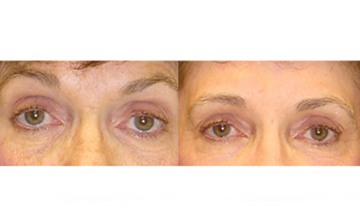 Before and after photo of an actual Eyelid Surgery patient.