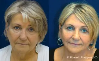 Before and after photo of an actual Eyelid Surgery patient.