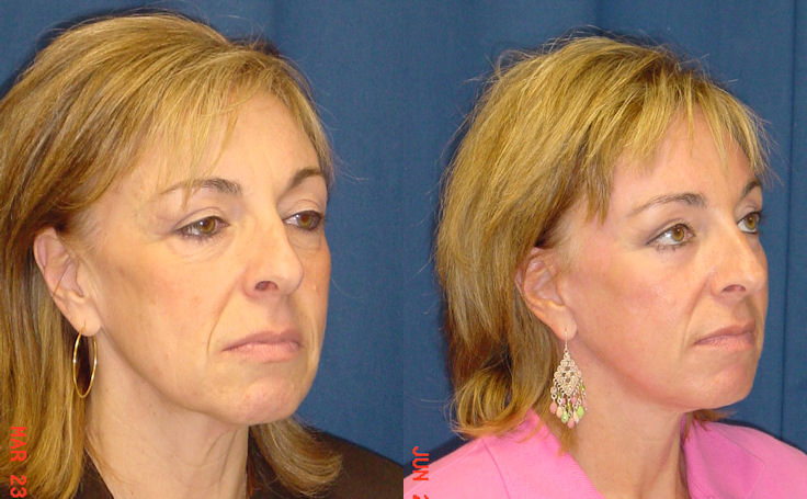 Before and after photo of an actual Facelift patient.