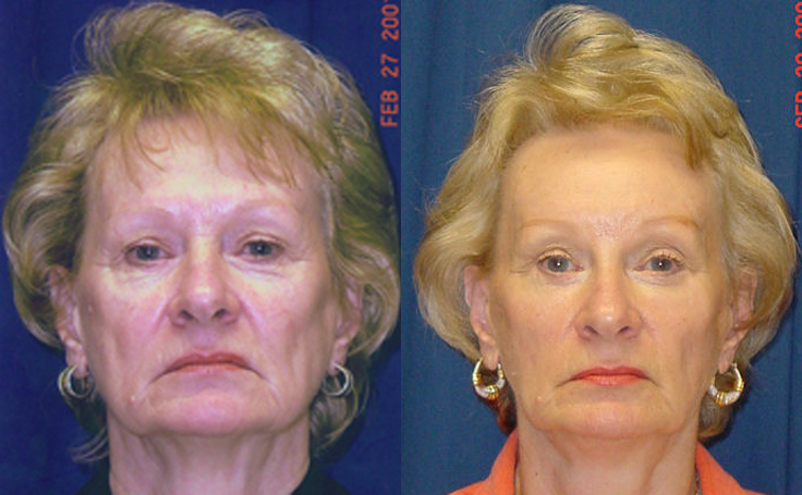 Before and after photo of an actual Facelift patient.