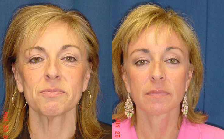 Before and after photo of an actual Facelift patient.