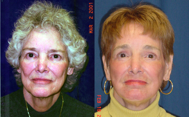 Before and after photo of an actual Facelift patient.