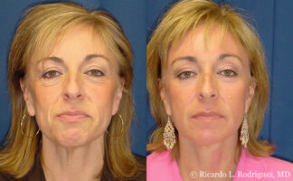 Real patient before and after full facelift and facial fat transfer by Dr. Ricardo Rodriguez in Baltimore, showing subtle, natural-looking rejuvenation