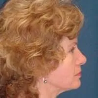 A side profile photo of a female head, showing the end result of a face lift.