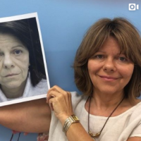 facial fat grafting patient holding up her pre-op photo