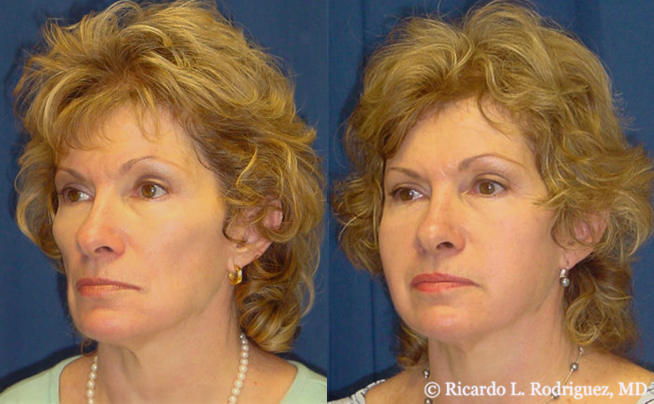 before and after facial fat transfer for facial rejuvenation