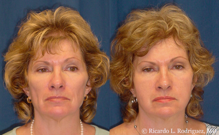 before and after facial fat transfer for facial rejuvenation