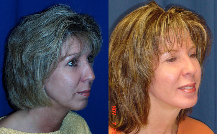 Before and after photo of an actual Facial Implants patient.