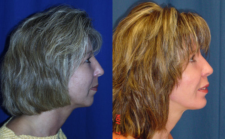 Before and after photo of an actual Facial Implants patient.