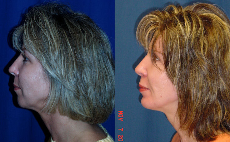 Before and after photo of an actual Facial Implants patient.