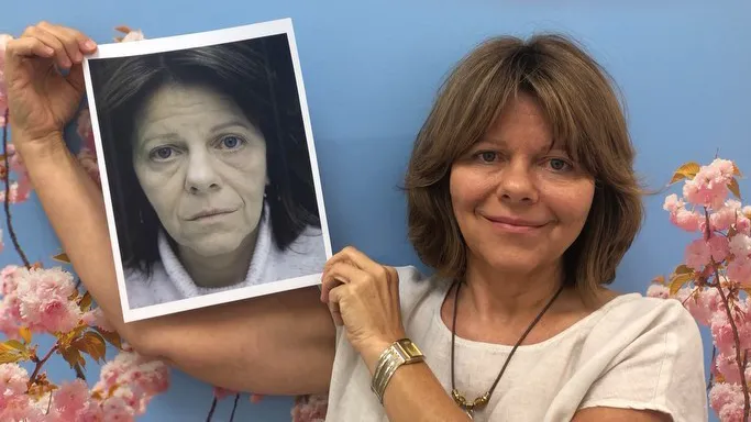 facial fat transfer patient holding her before photo