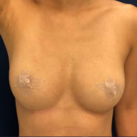 fat graft breast aug after photo