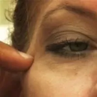 A photo of a patient's face, zoomed in on her right eye, showing bags under the eye.