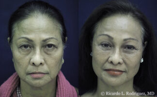 Real patient after brow lift and facial fat transfer by Dr. Ricardo Rodriguez in Baltimore