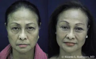 Real patient after brow lift and facial fat transfer by Dr. Ricardo Rodriguez in Baltimore