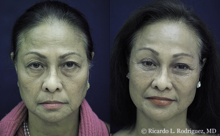 Real patient after brow lift and facial fat transfer by Dr. Ricardo Rodriguez in Baltimore
