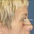 A side view photo of a female face with illustrations showing where the fat-injections will be applied.