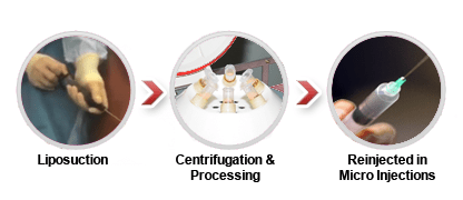 Illustration of the 3 components of fat transfer.