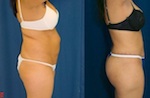 A collage of photos (side view) of a patient before and after Fat injections to the hip.