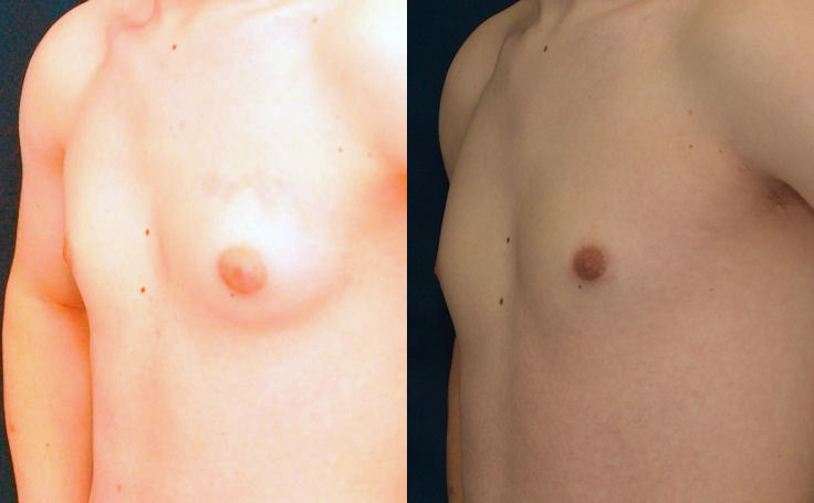 Before and after photo of an actual Gynecomastia patient.