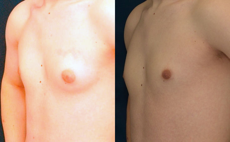 Before and after photo of an actual Gynecomastia patient.