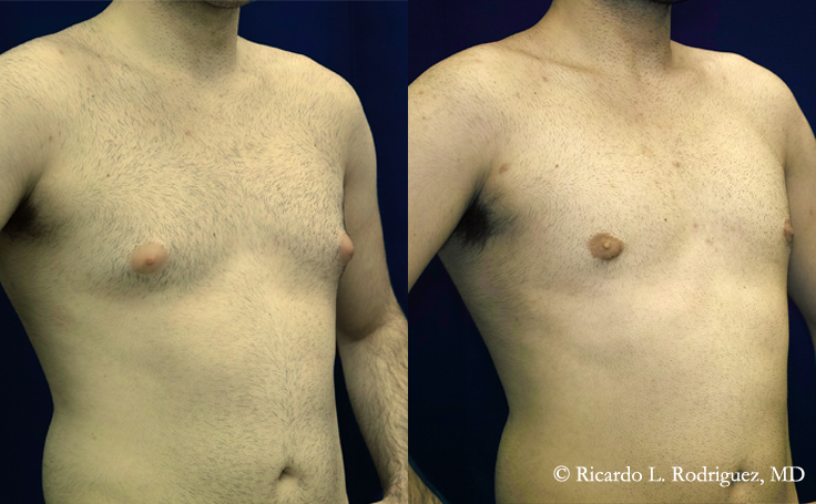 Before and after photo of an actual Gynecomastia patient.