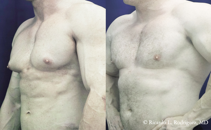 Before and after photo of an actual Gynecomastia patient.