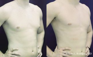 Before and after photo of an actual Gynecomastia patient.