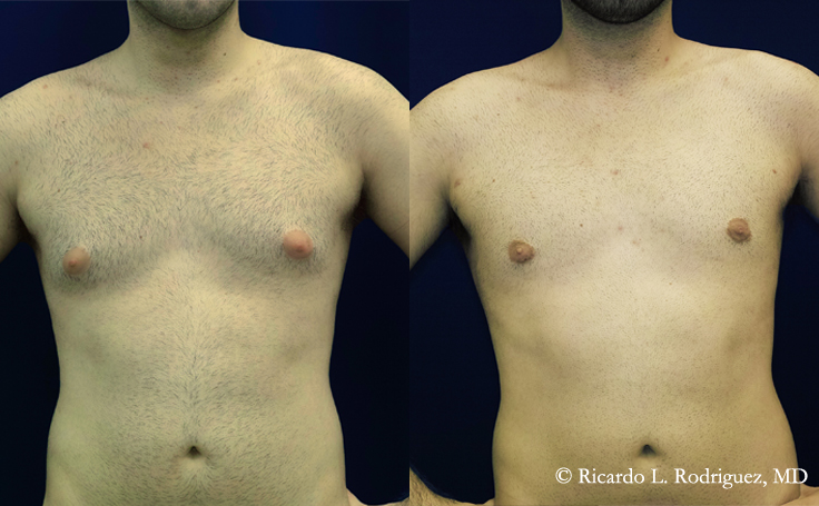 Before and after photo of an actual Gynecomastia patient.