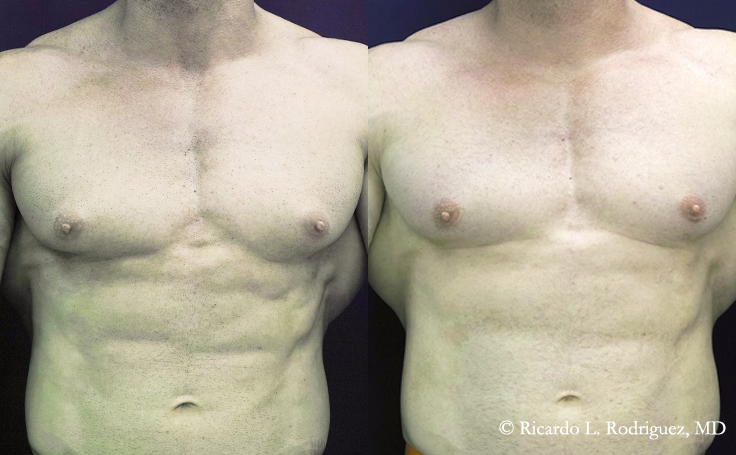 Before and after photo of an actual Gynecomastia patient.