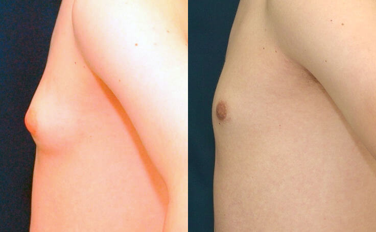 Before and after photo of an actual Gynecomastia patient.