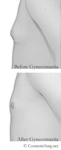 Before & after Gynecomastia patient illustration.