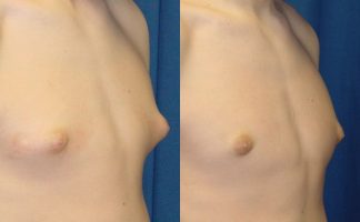 Before and after photo of an actual Gynecomastia patient.