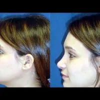 A collage of photos (side view) of a patient before & after a Rhinoplasty procedure.