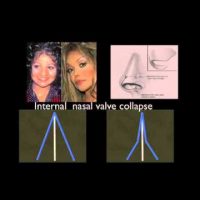 A collage of photos that illustrate internal nasal valve collapse.