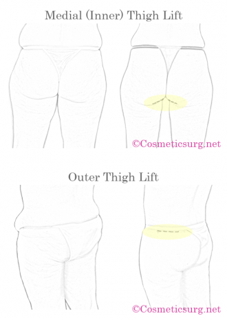 Thigh lift (Inner and Outer Thigh Lift) - Dr. Rodriguez