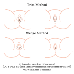 Trim and wedge labiaplasty methods diagram.