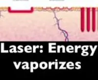 An illustration showing how laser vaporizes cells.