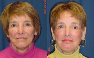 Before and after photo of an actual Laser Skin Resurfacing patient.