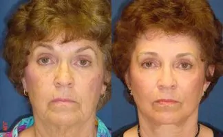 Before and after photo of an actual Laser Skin Resurfacing patient.