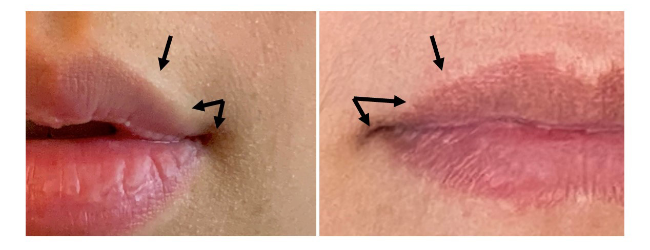 close up of two different faces illustrating the corner of the mouth and the white roll of the lip with arrows pointing to the anatomical features