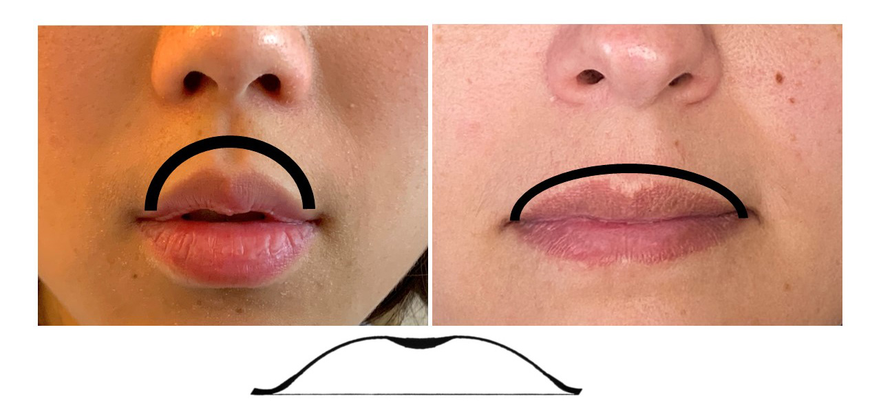 close up of two different faces illustrating the cupid's bow with lines above the anatomical features, along with the cupid's bow shape below the faces