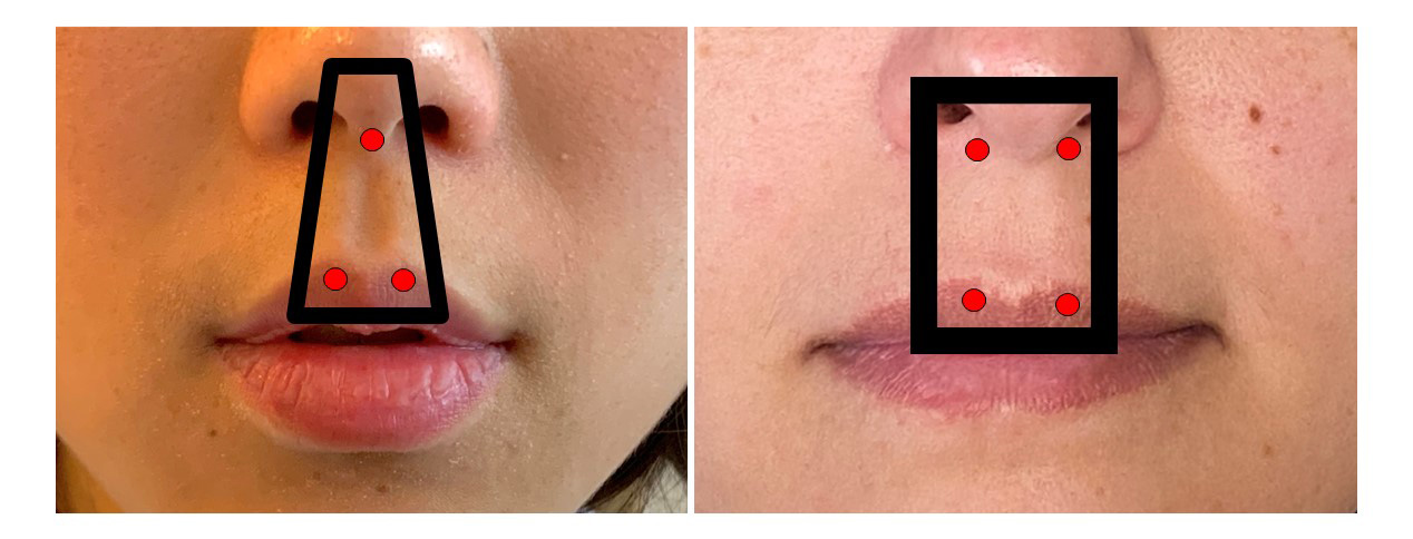 close up of two different faces illustrating the philtrum with red circles and lines surrounding the shape of the anatomical features