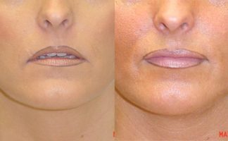 Before and after photo of an actual Lip Augmentation patient.