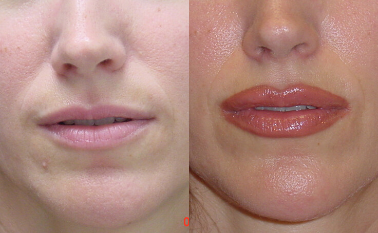 Before and after photo of an actual Lip Augmentation patient.