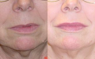 Before and after photo of an actual Lip Augmentation patient.