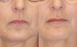 Before and after photo of an actual Lip Augmentation patient.