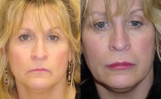 Before and after photo of an actual Lip Augmentation patient.